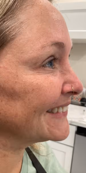 A woman’s side profile after Dysport treatment without crow’s feet