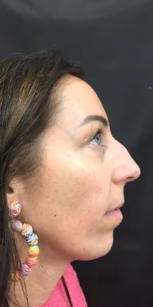 A woman’s side profile after dermal filler