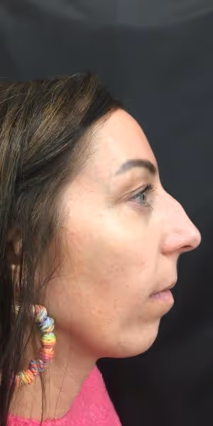 A woman’s side profile before dermal filler