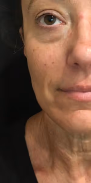 Close-up of half a woman’s face before dermal filler