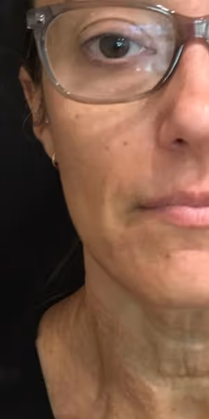 Close-up of half a woman’s face after dermal filler