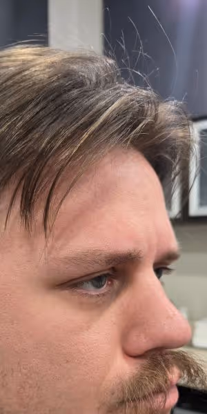 A man’s side profile after Botox treatments without forehead wrinkles