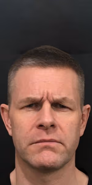 A man’s face with frown lines before Botox treatments