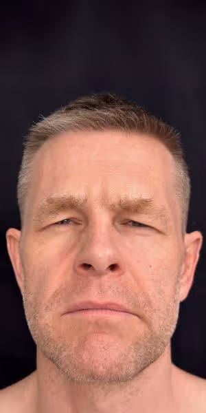 A man’s face after Botox treatments without frown lines