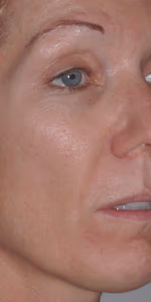Close-up of one side of a woman’s face after dermal filler