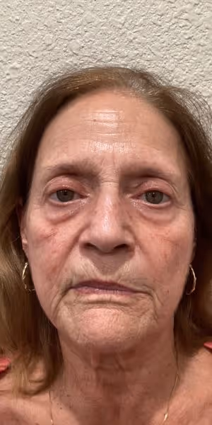 A woman’s face before lip filler and dermal filler treatments