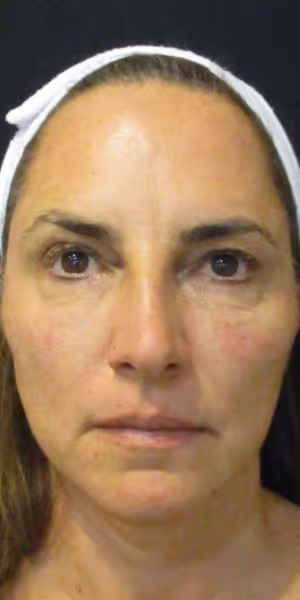 Close-up of a woman’s face after dermal filler