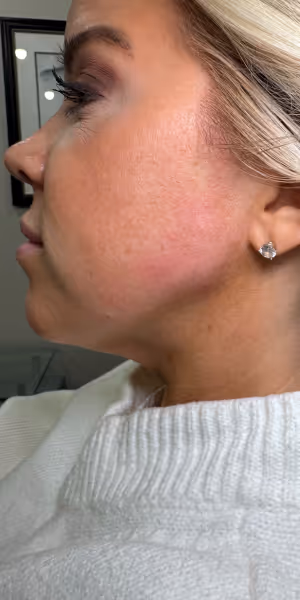 Close-up of a woman’s cheek and jaw after dermal filler