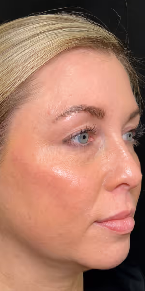 Close-up of the right side of a woman’s face after dermal filler