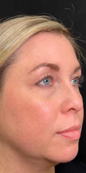 Close-up of the right side of a woman’s face before dermal filler