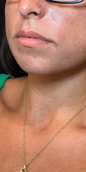 Close-up of a woman's lips before lip filler