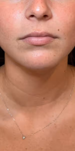Close-up of a woman's lips before lip filler