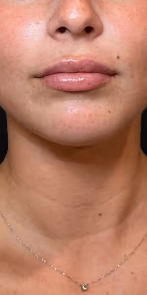 Close-up of a woman's lips after lip filler
