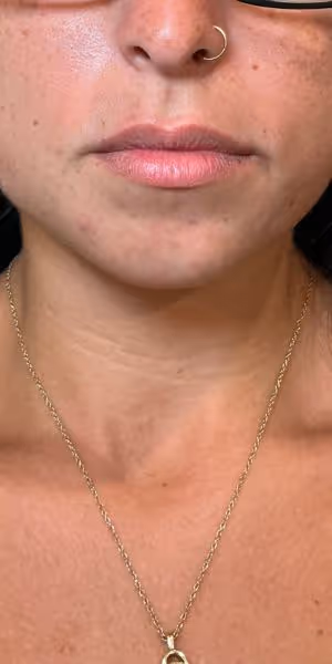 Close-up of a woman's lips before lip filler