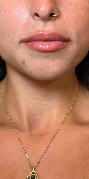 Close-up of a woman's lips after lip filler