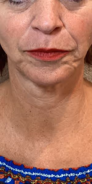 A woman’s lower face and neck before Sculptra and Dysport treatments.