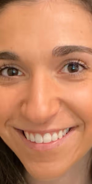 A woman’s face before Botox treatments