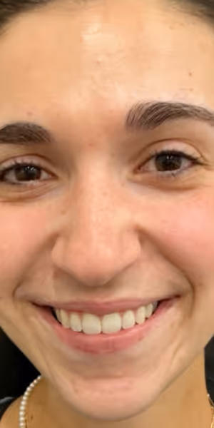 A woman’s face after Botox treatments