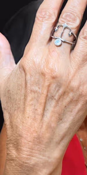 Close-up of the back of a woman's hand before dermal filler treatment