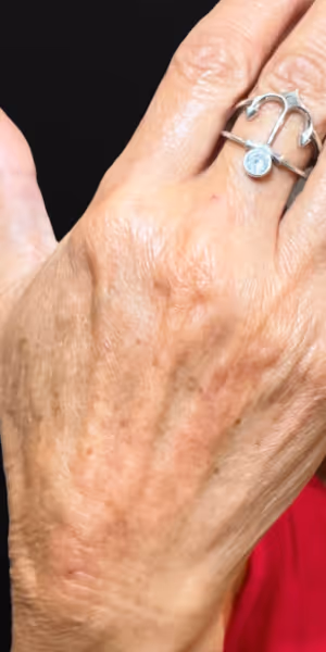 Close-up of the back of a woman's hand after dermal filler treatment