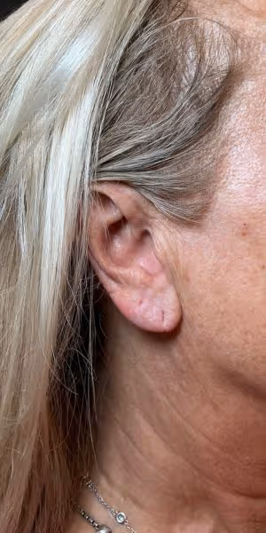 Close-up of a woman's ear and neck after dermal filler treatment.