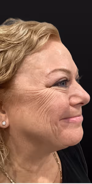 A woman’s side profile before Botox treatments