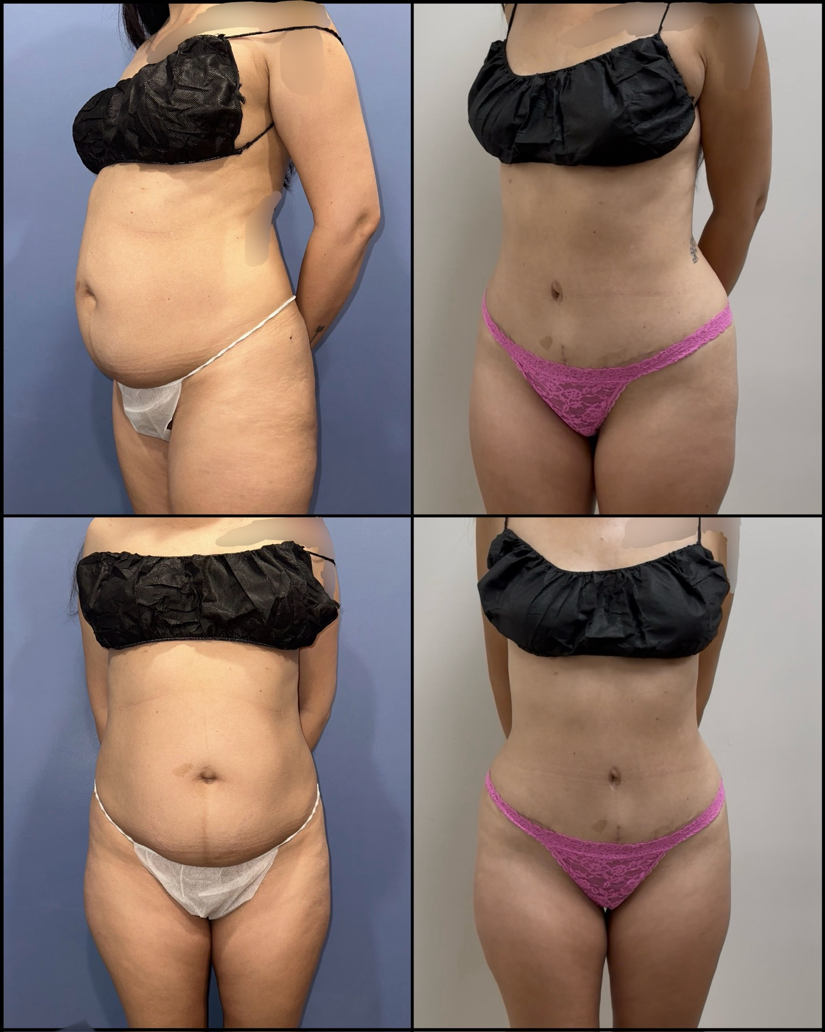 Gentle touch tummy tuck (liposuction, abdominoplasty)