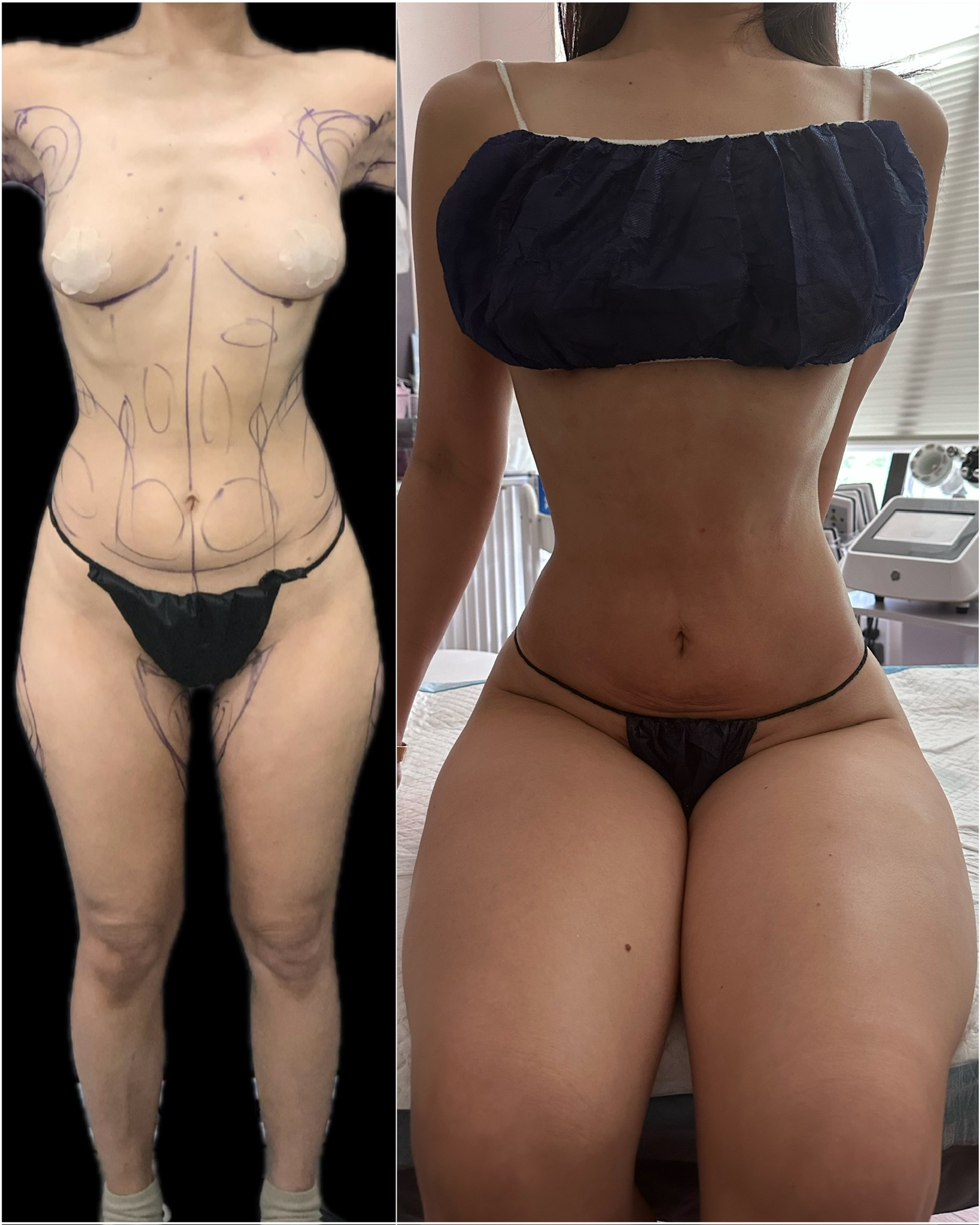 Liposuction 360 + inner thighs + outer thighs