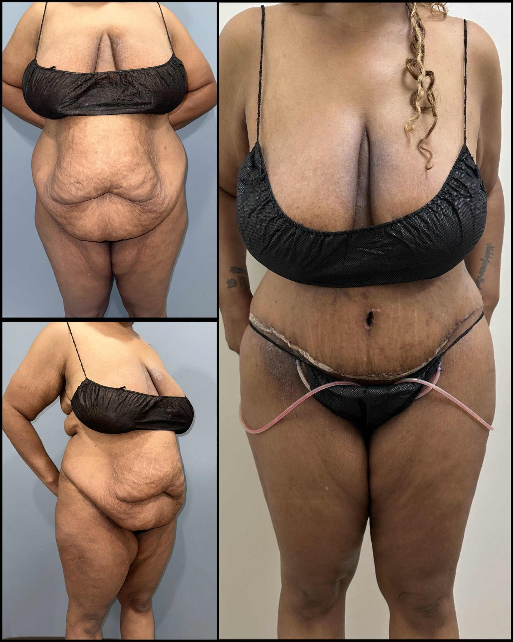 Gentle touch tummy tuck (liposuction, abdominoplasty)
