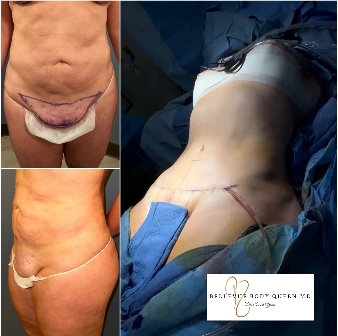 Pubic liposuction + pubic lift 