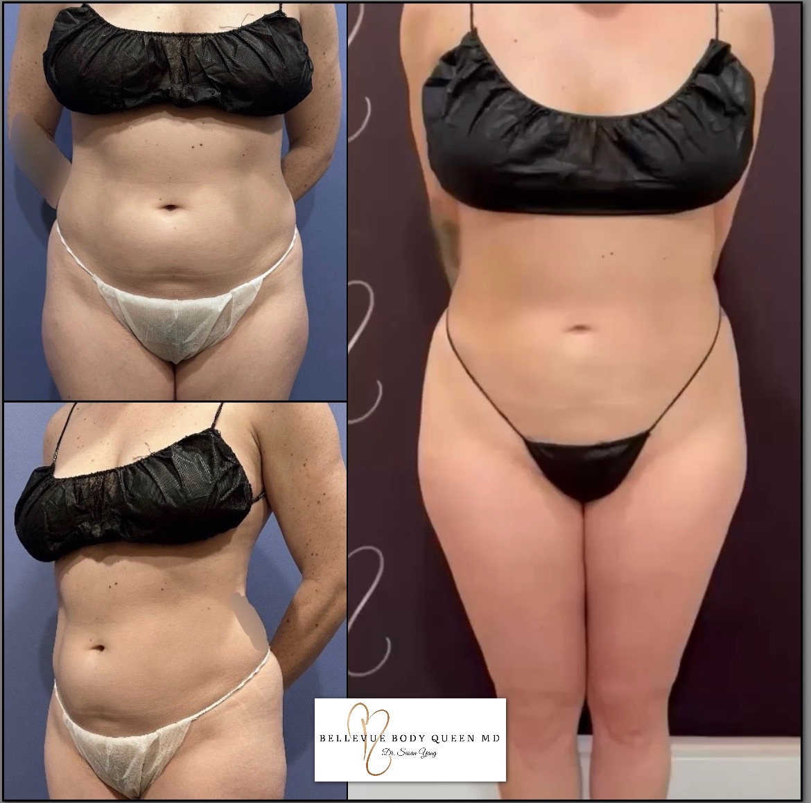 Liposuction Abdomen, Waist, Flanks