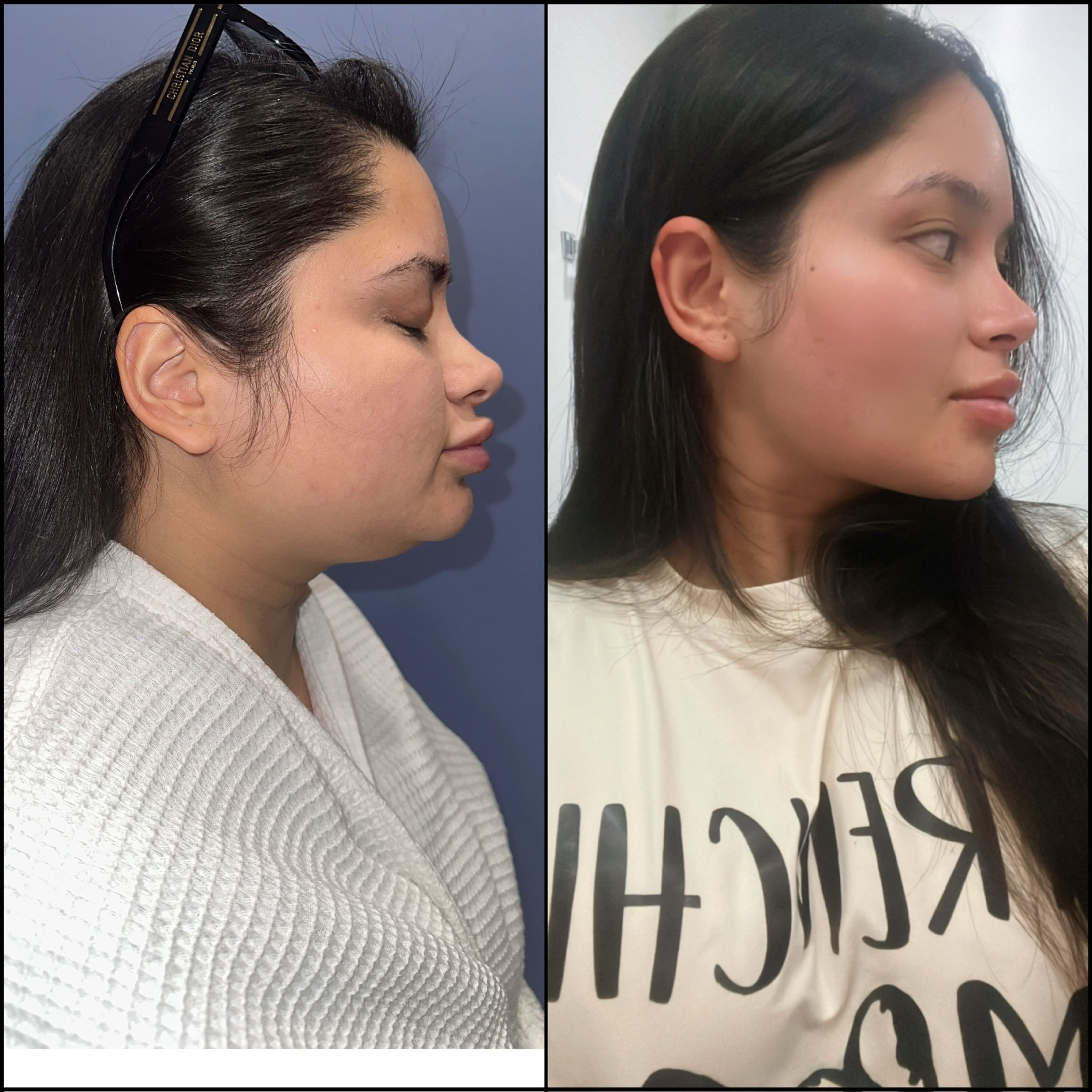 Liposuction Chin, extended