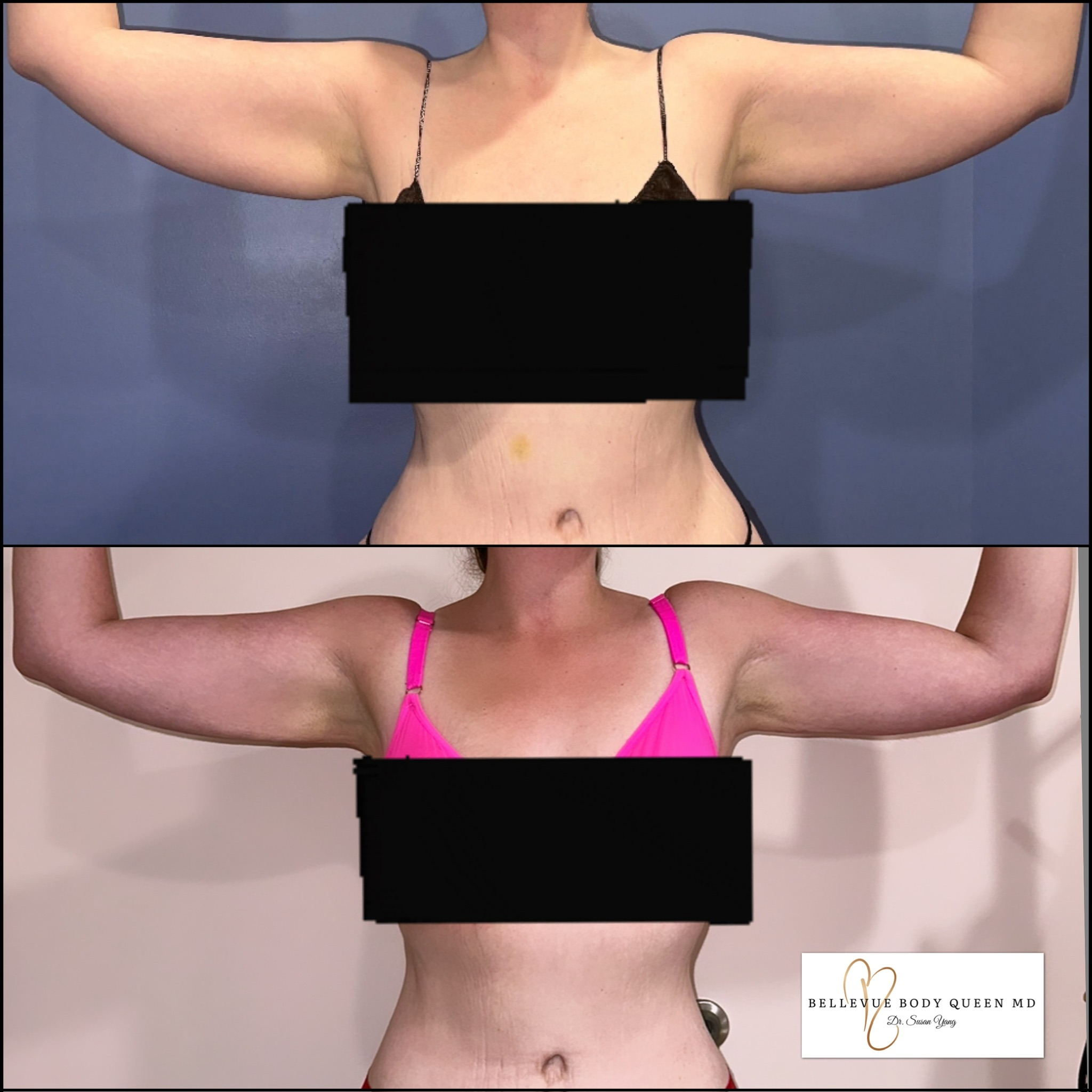 Liposuction Arms