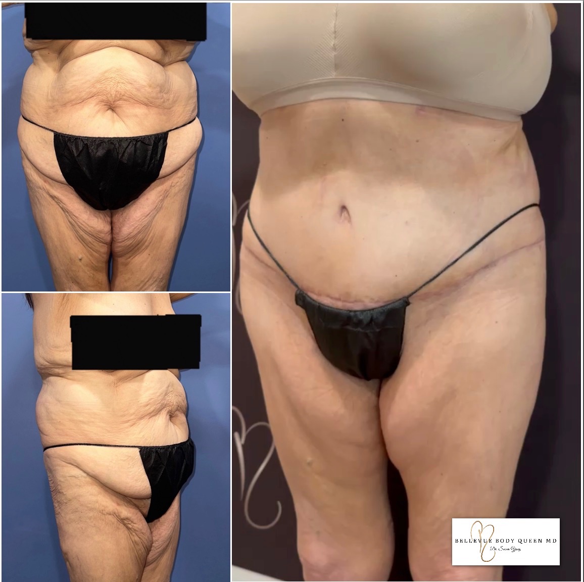 Gentle touch tummy tuck 