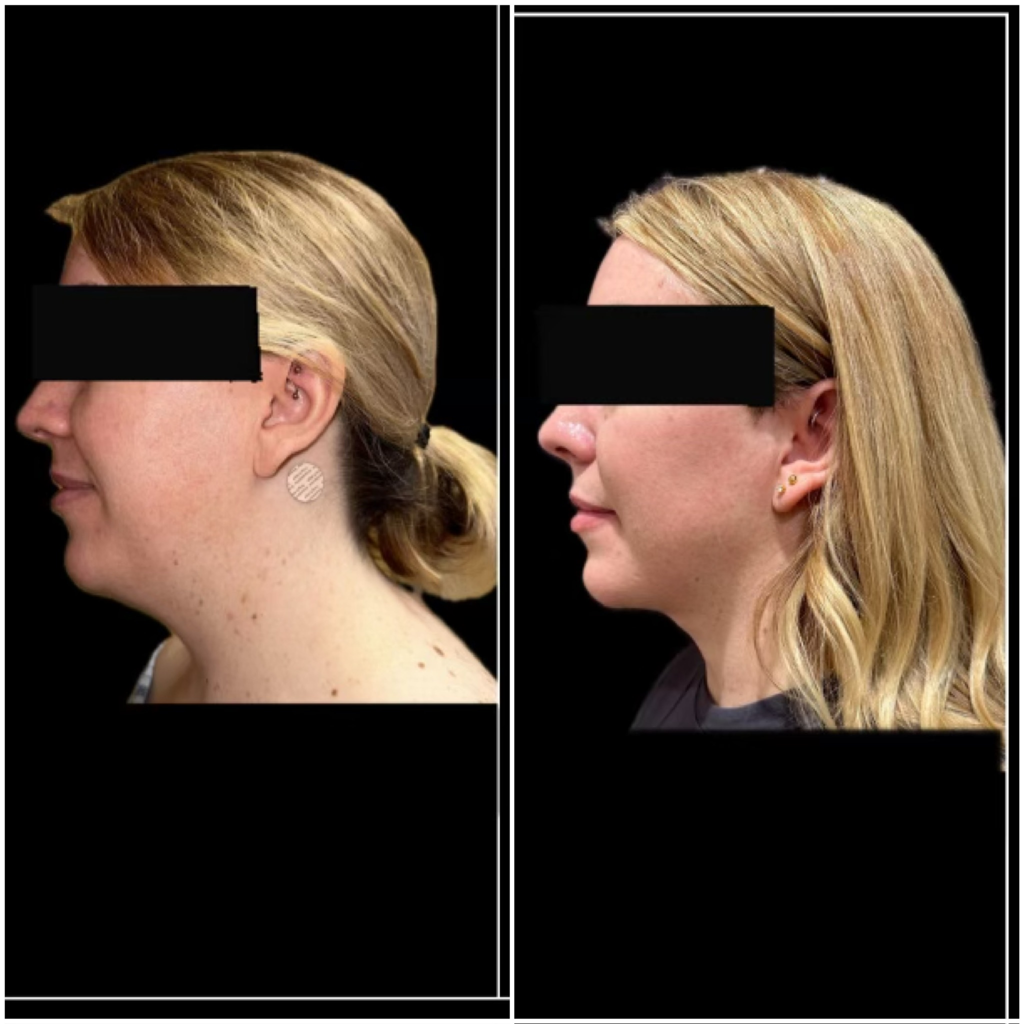 Liposuction Chin