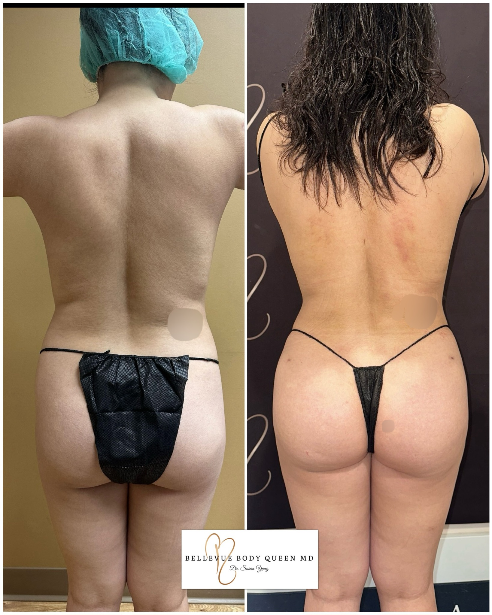 Liposuction 360, BBL