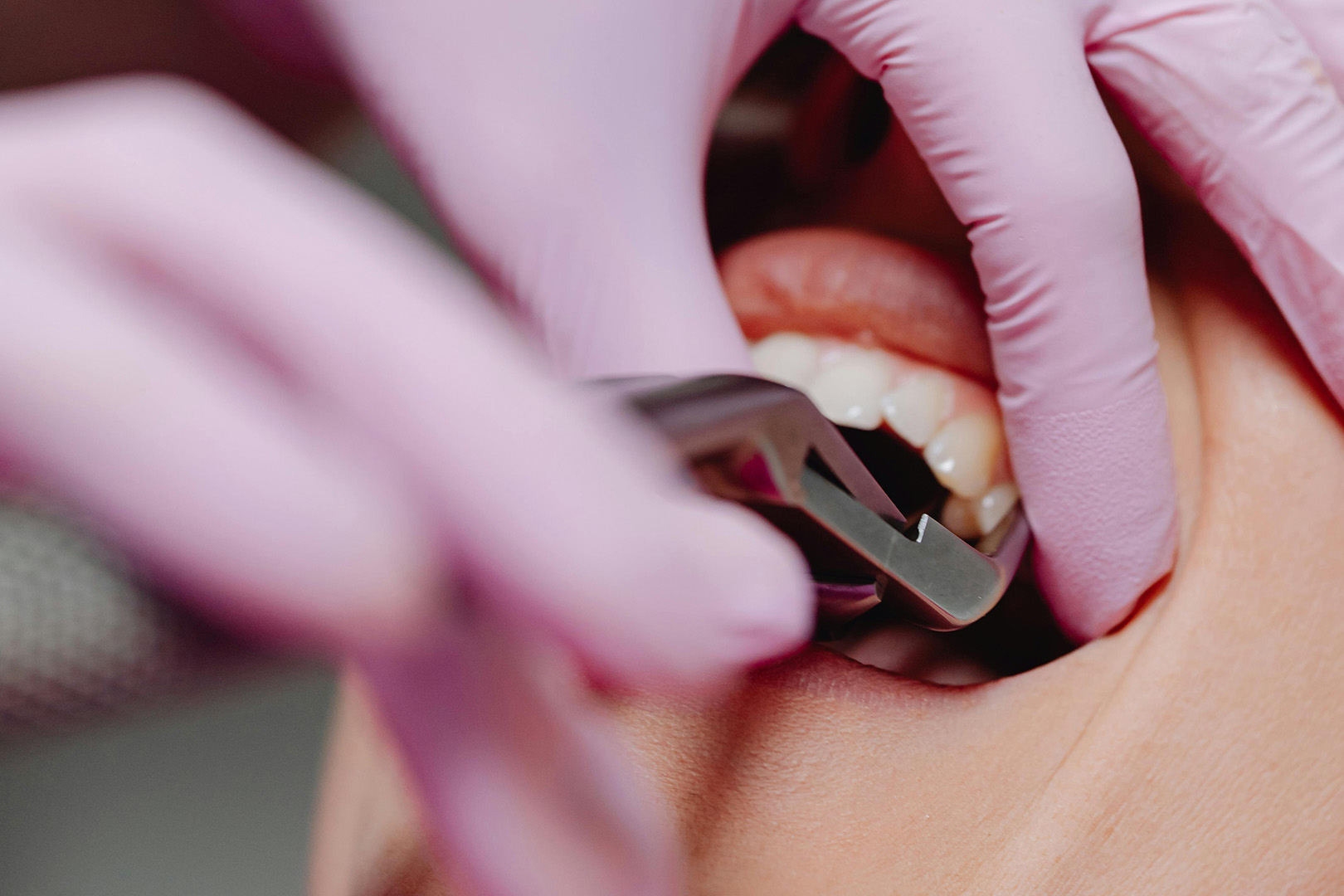 Operacyjne usunięcie zęba Apolonia Dental Szczecin 