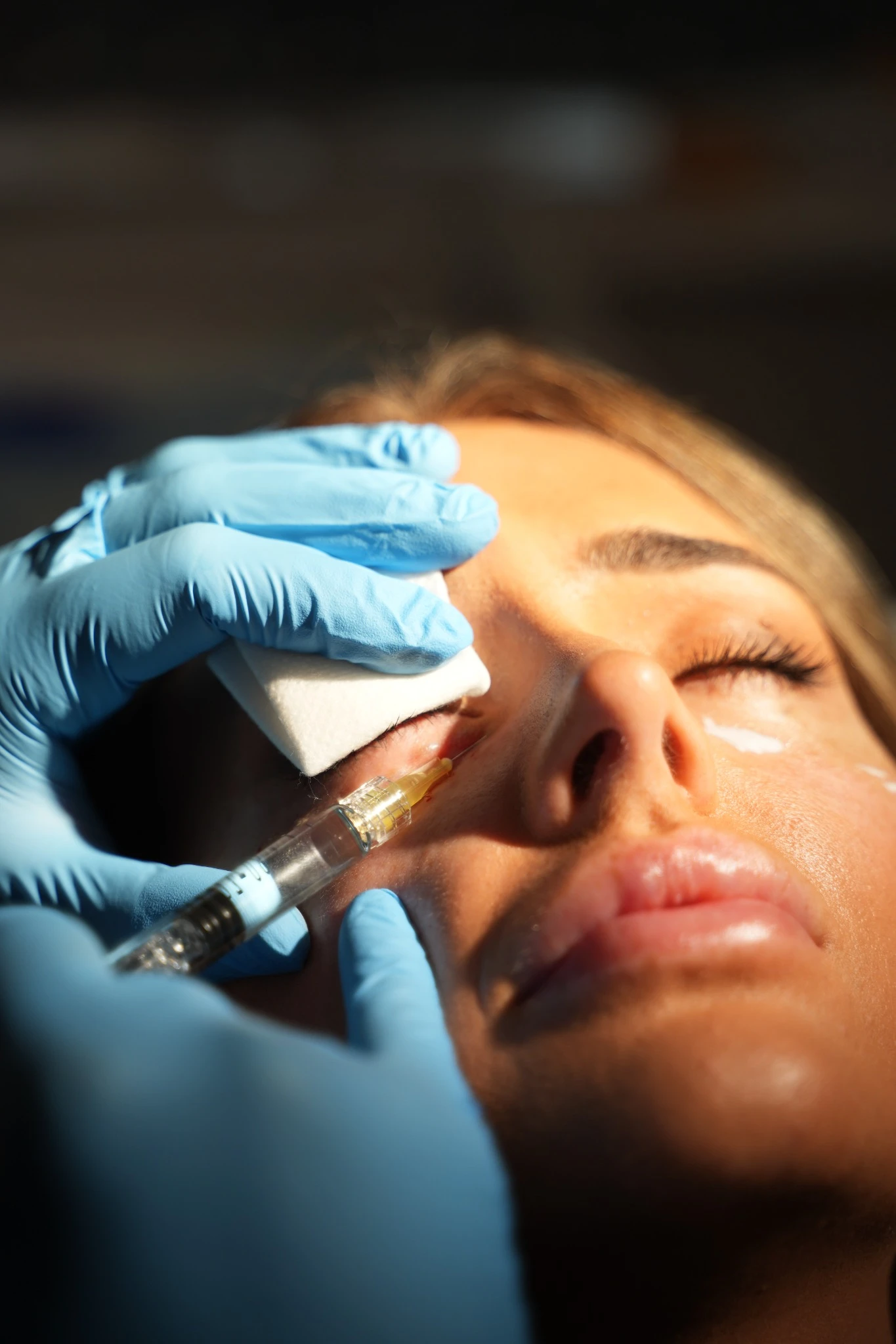 Polynucleotides Under Eyes Leeds at Skinfinity Clinic