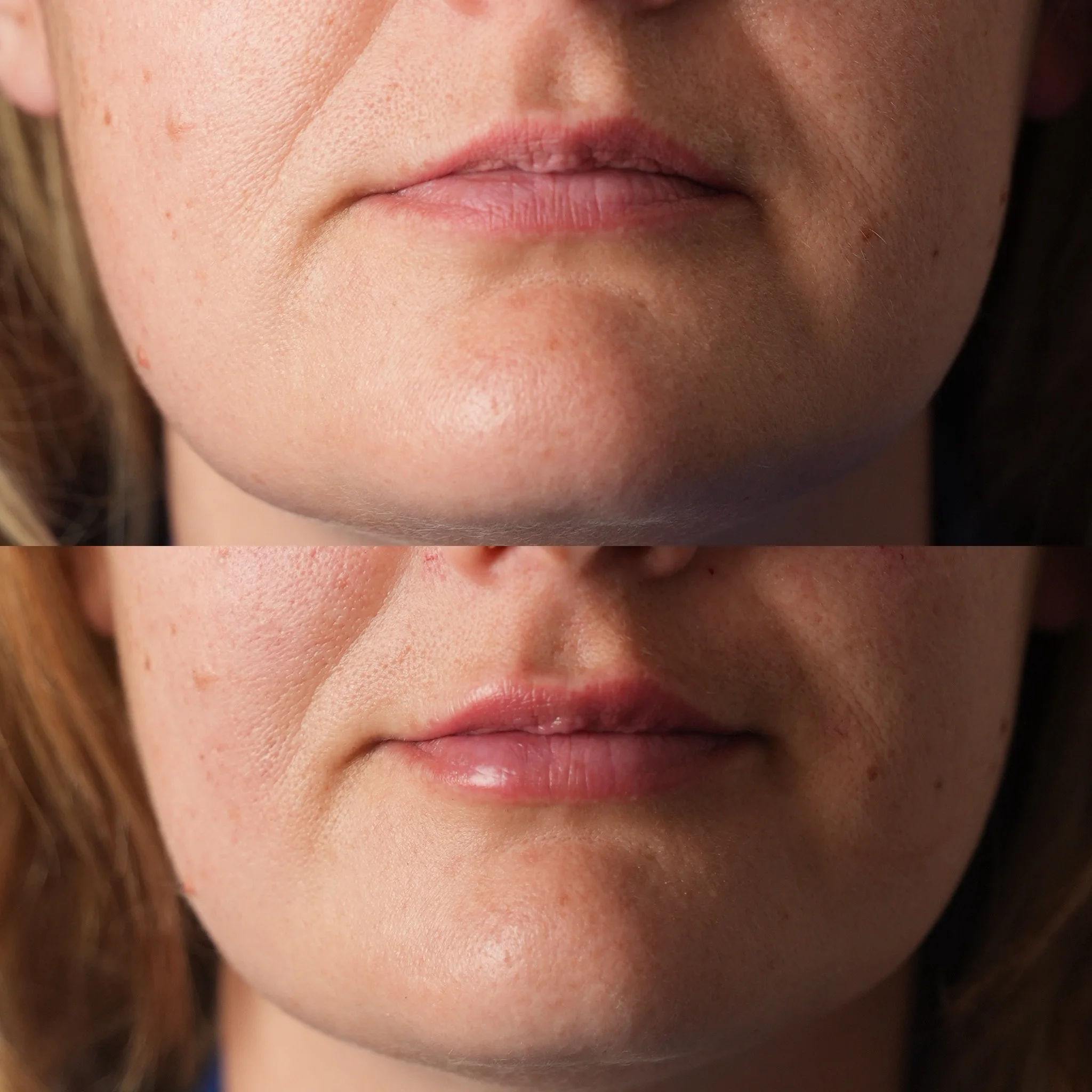Natural Lip Fillers at Skinfinity Leeds - Before and after lip filler