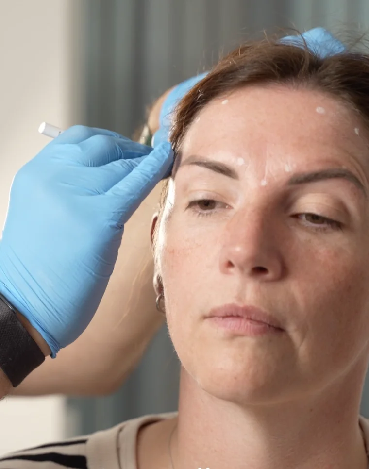 migraine treatment with anti-wrinkle injections Leeds