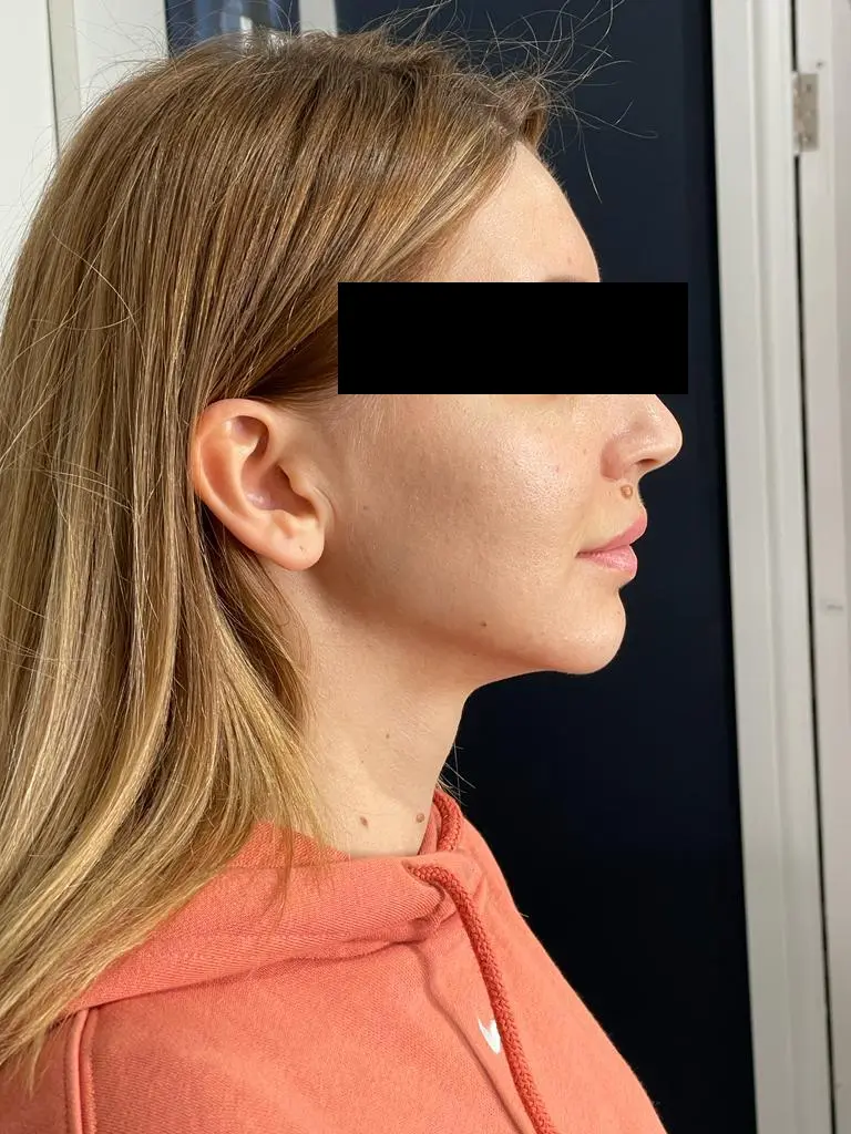 Non-surgical nose job Leeds