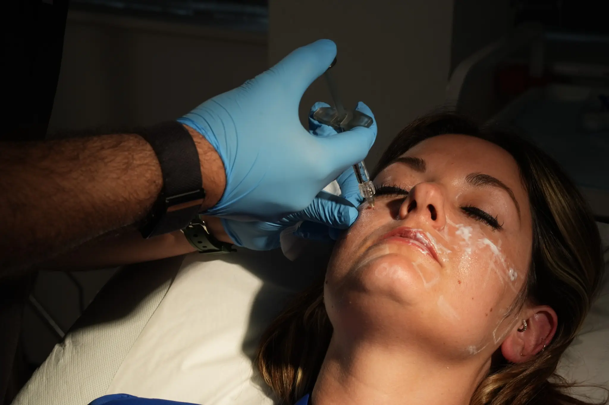 Cheek filler injections