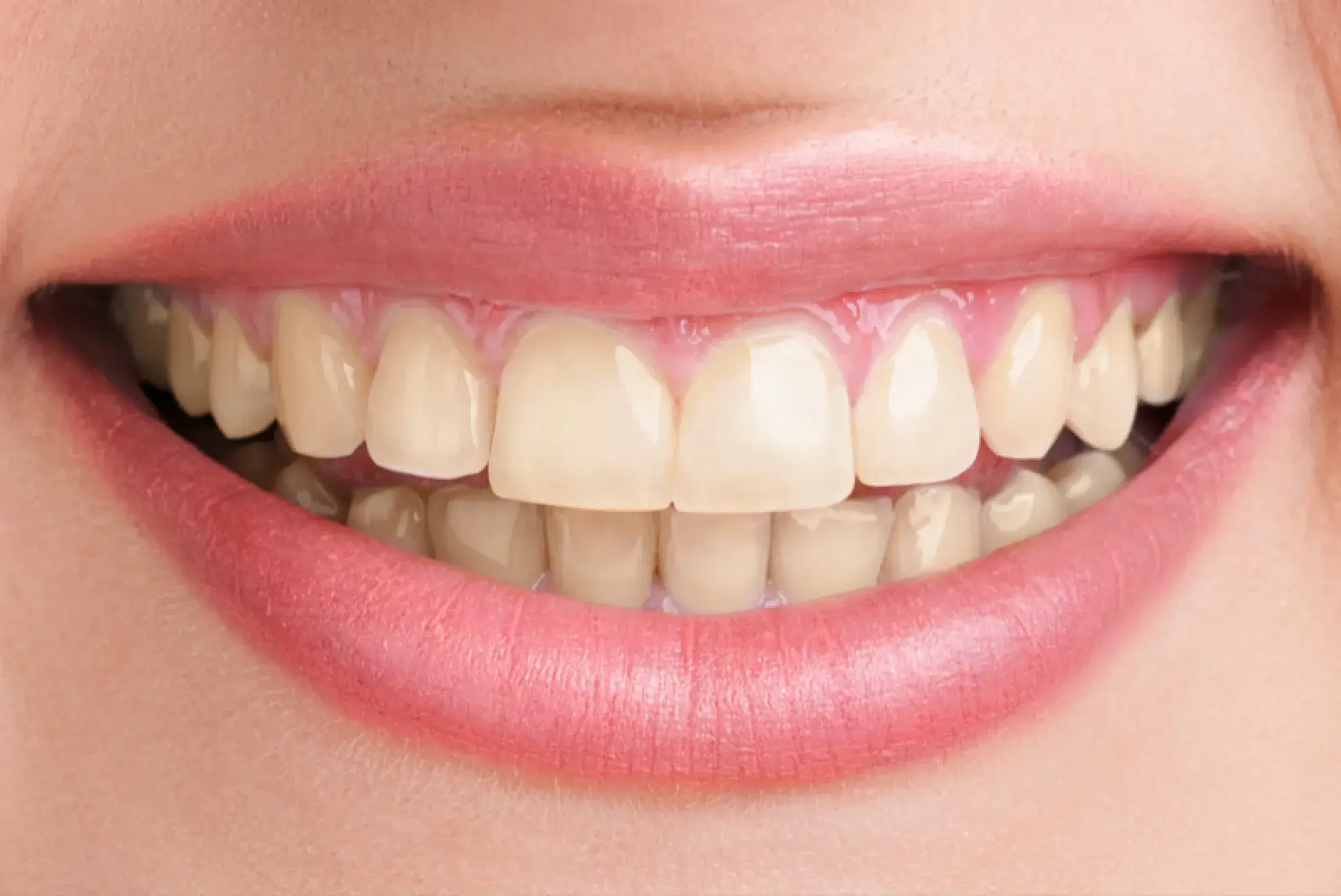 A close up of a woman's smile with white teeth.
