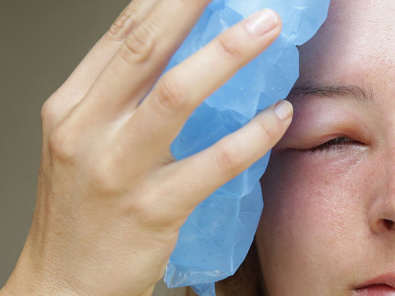 wasp sting on the eye