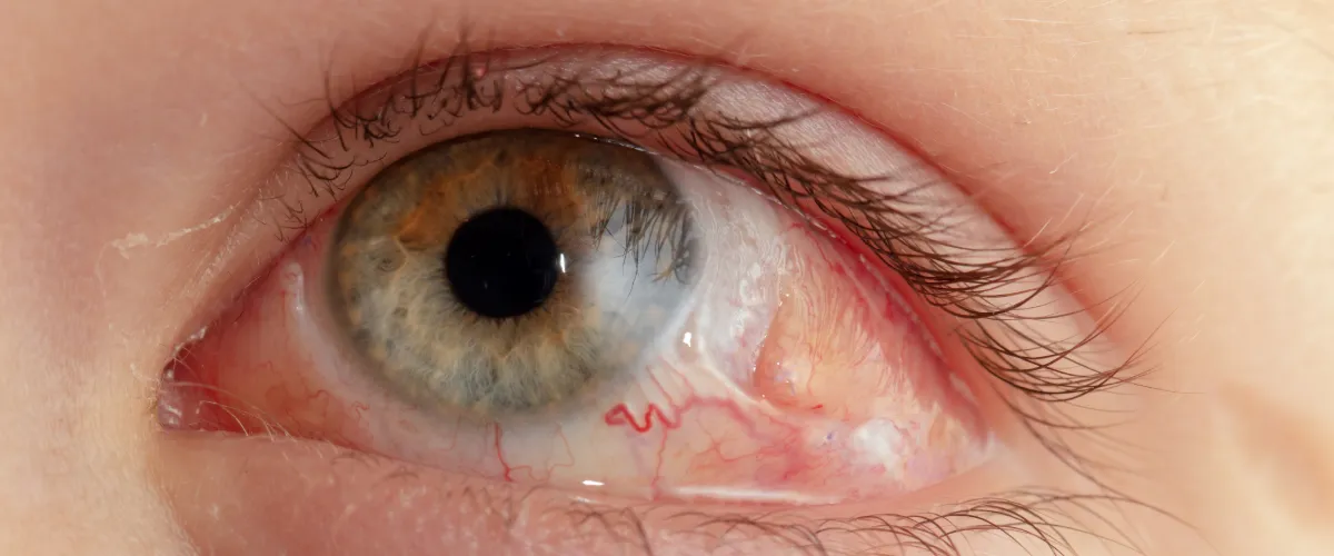 Close-up of an eye showing redness and visible blood vessels near the inner corner and sclera.