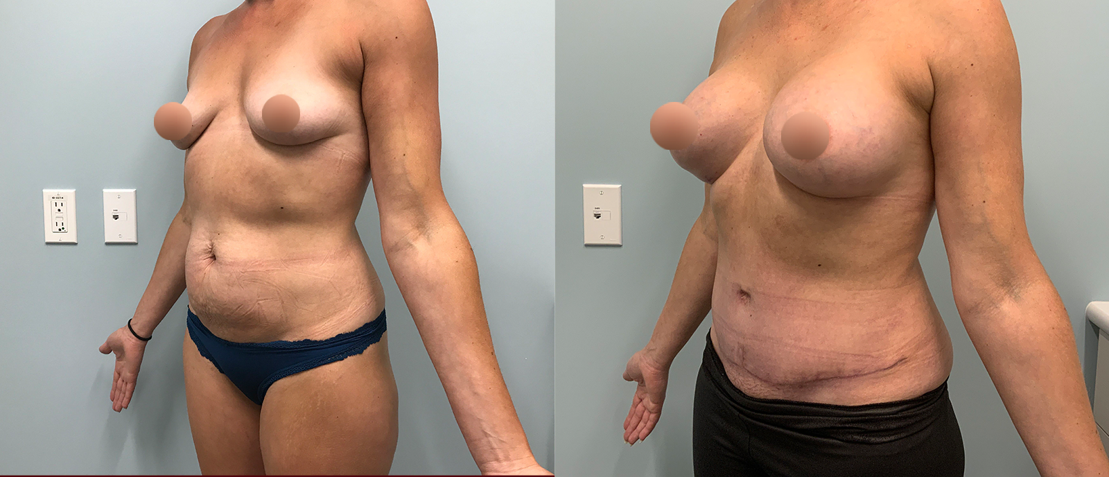 Three Quarter Profile Photo Showing the Before & After Results of a Mommy Makeover