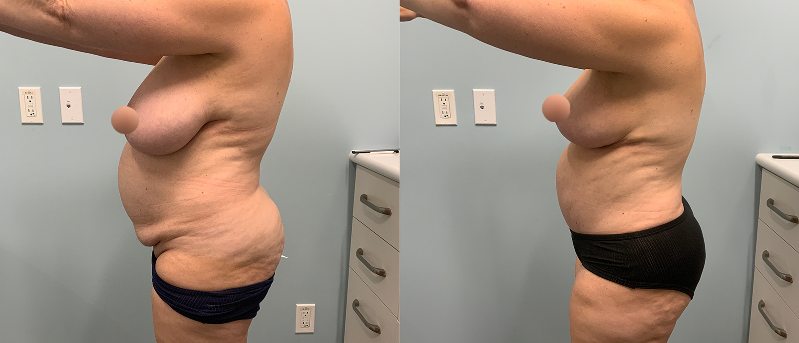 Side Profile Photo Showing the Before & After Results of a Mommy Makeover