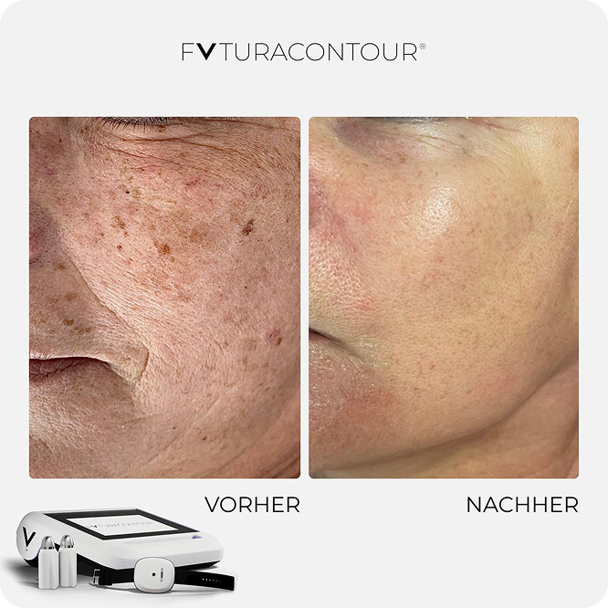 futuracontour_beforeandafter