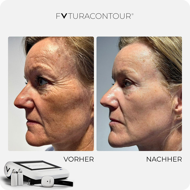 futuracontour_beforeandafter