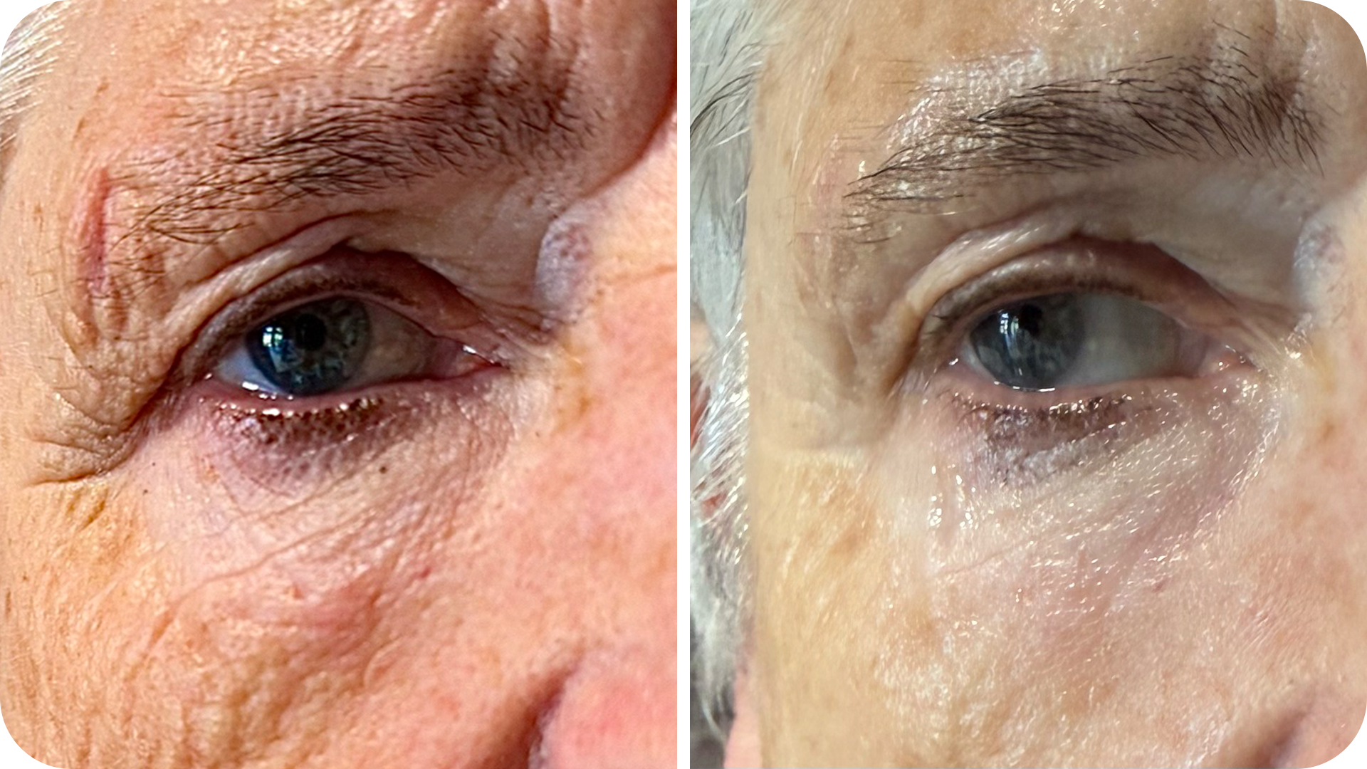 futuracontour_beforeandafter